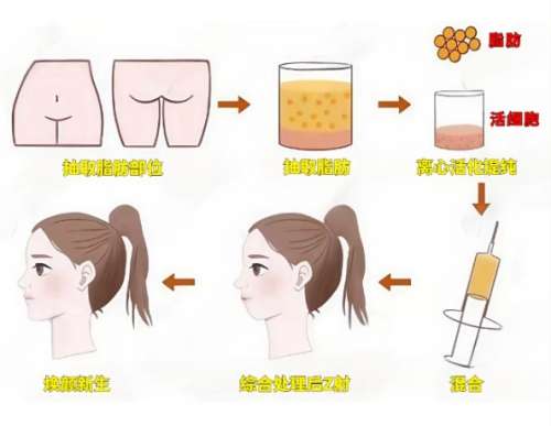 自体脂肪填充 自体脂肪填充
