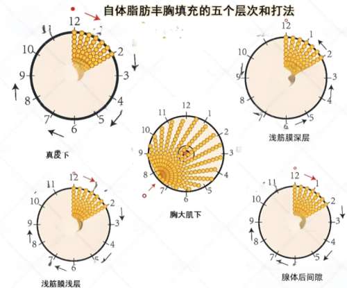 脂肪丰胸 脂肪丰胸