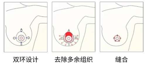 隆胸 隆胸