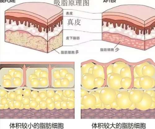 面吸 面吸