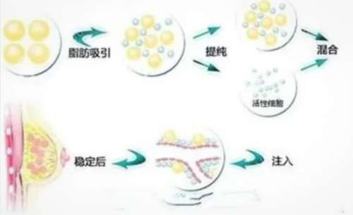 自体脂肪填充隆 自体脂肪填充隆