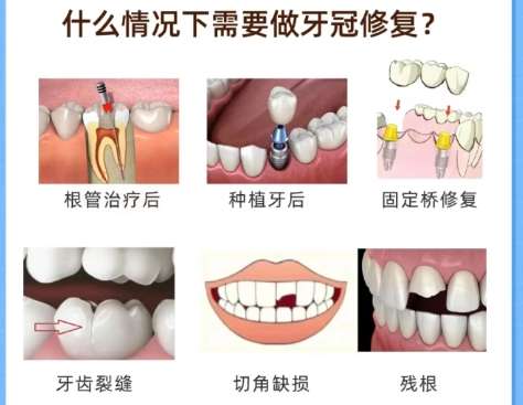 牙齿修复 牙齿修复