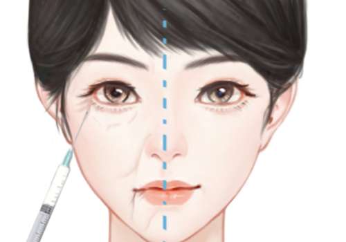 玻尿酸去面部细纹.jpg