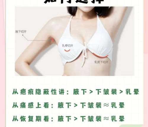隆胸 隆胸