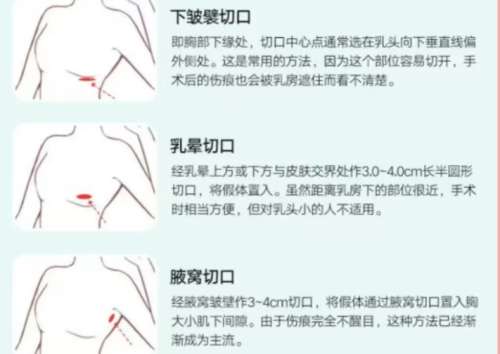 隆胸 隆胸