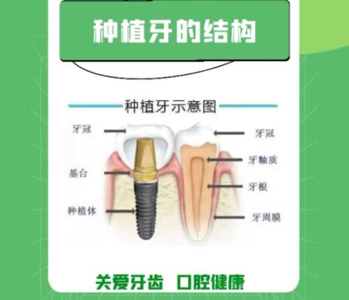 牙齿种植 牙齿种植
