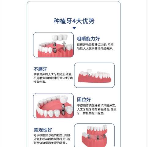 牙齿种植 牙齿种植