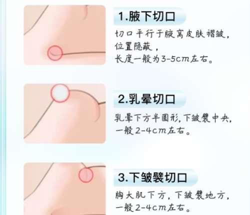 隆胸 隆胸