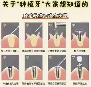 牙齿种植 牙齿种植