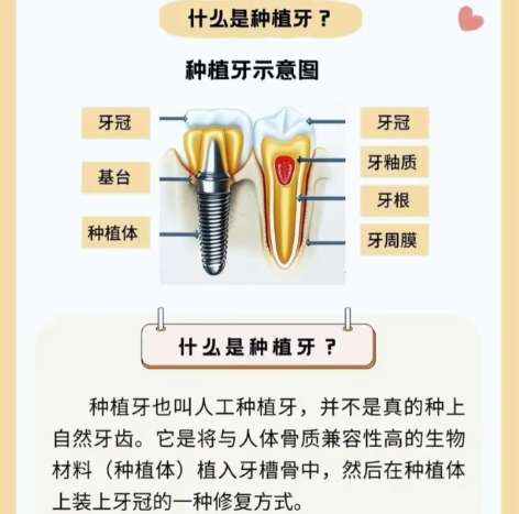 牙齿种植 牙齿种植