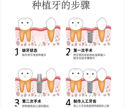 牙齿种植 牙齿种植