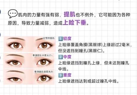 双眼皮 双眼皮