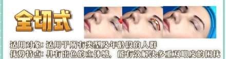 双眼皮 双眼皮