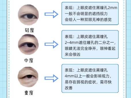 双眼皮 双眼皮