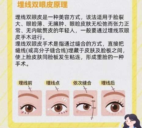双眼皮 双眼皮