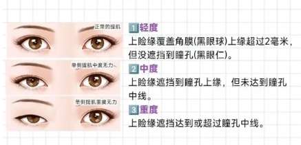 双眼皮 双眼皮
