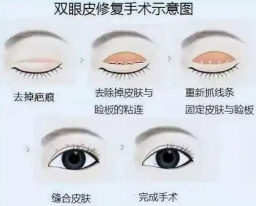 双眼皮 双眼皮