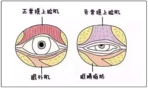 双眼皮 双眼皮