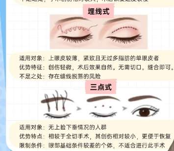 双眼皮 双眼皮