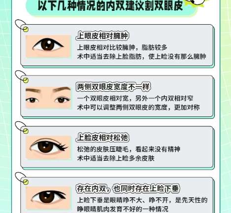 双眼皮 双眼皮