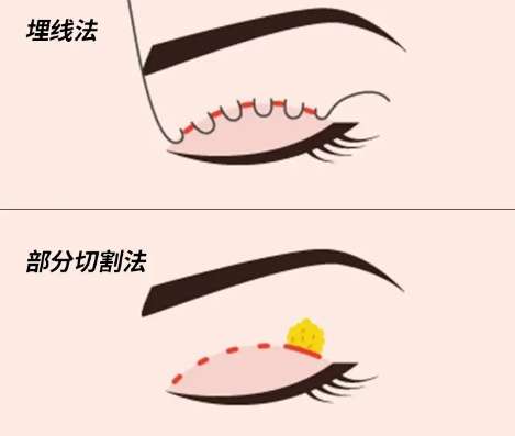 双眼皮 双眼皮