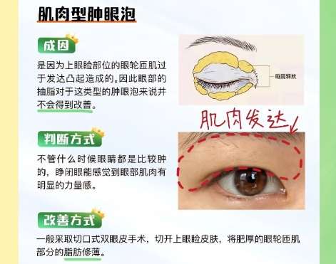 双眼皮 双眼皮