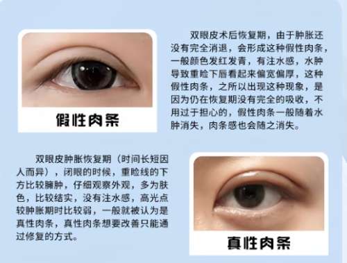 双眼皮 双眼皮