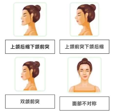 正颌 正颌