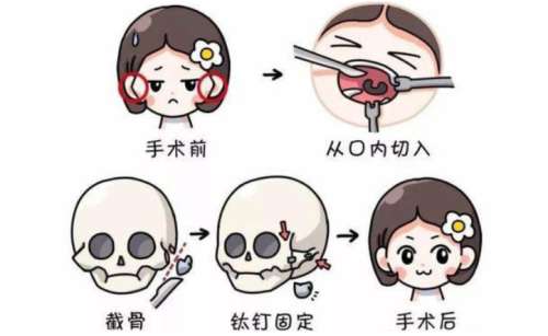 磨骨 磨骨
