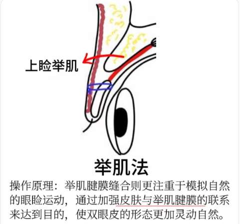 双眼皮 双眼皮