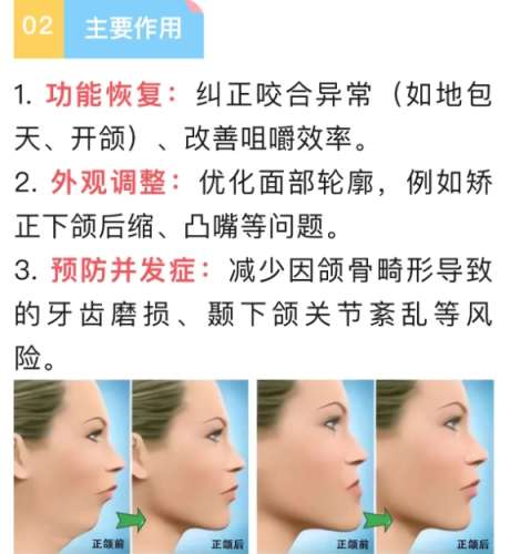 正颌手术 正颌手术
