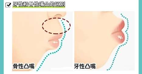 凸嘴 凸嘴
