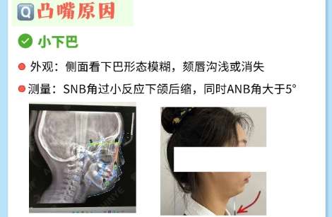 凸嘴矫正 凸嘴矫正