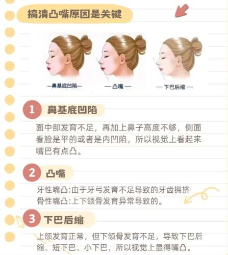 凸嘴矫正.jpg 凸嘴矫正.jpg