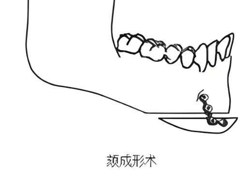颏成型2.jpg