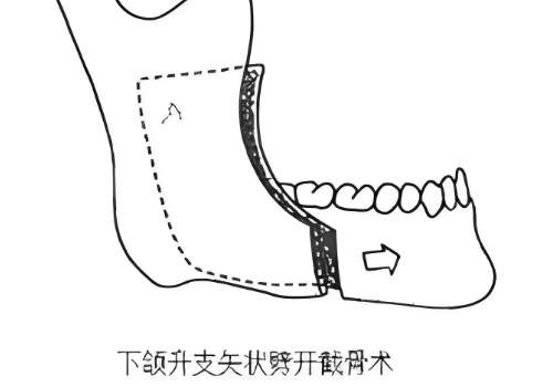 颏成型1.jpg