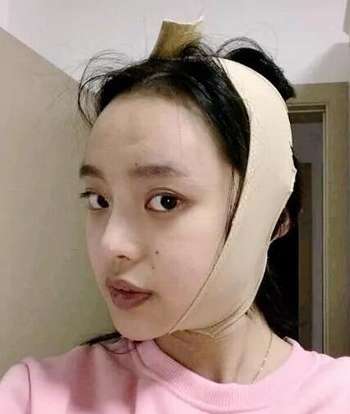 下颌角磨骨3.jpg