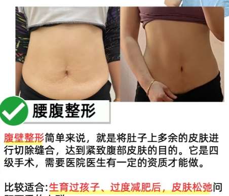 吸脂 吸脂
