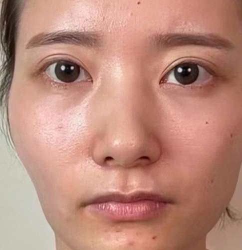 嘴角下垂矫正1.jpg