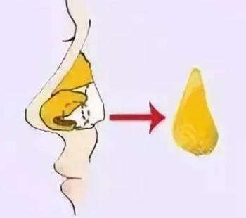 隆鼻 隆鼻