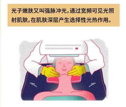 光子嫩肤 光子嫩肤