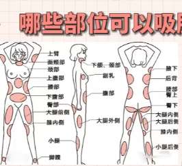 吸脂 吸脂