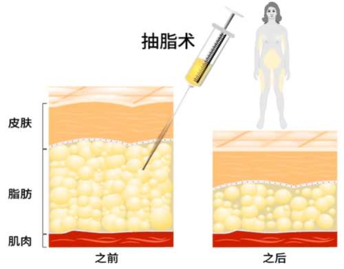 吸脂 吸脂