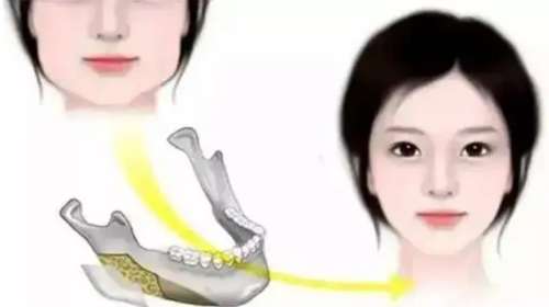磨骨 磨骨
