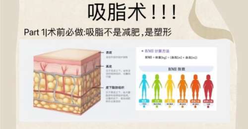 吸脂 吸脂
