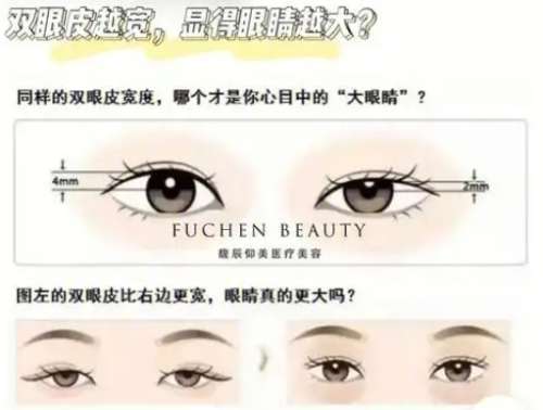 双眼皮 双眼皮