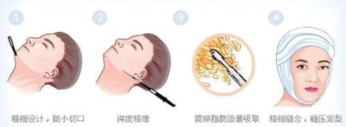 吸脂 吸脂