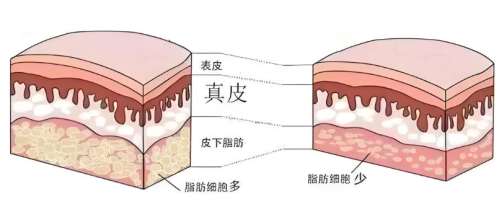 吸脂 吸脂