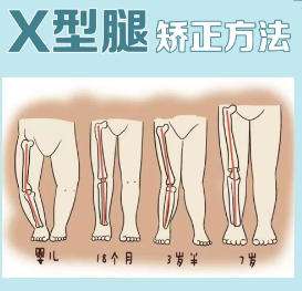 四肢畸形矫正 四肢畸形矫正