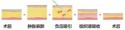 吸脂 吸脂